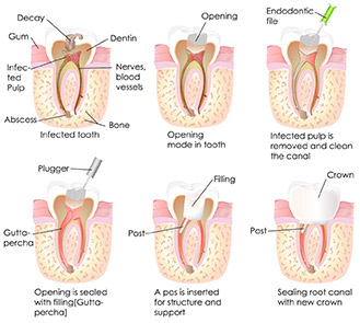 (root canal La Crosse, WI.jpg