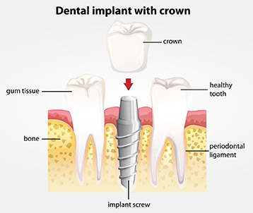 dental-implants.jpg