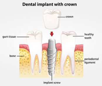 dental-implants.jpg
